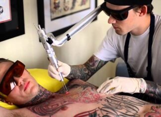 удаление татуировок лазером